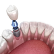 Kien Thuc Implant