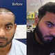 hair transplant